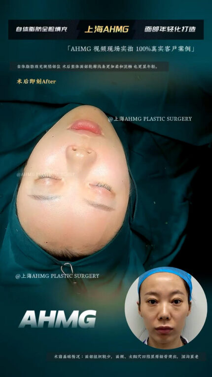 Facial rejuvenation